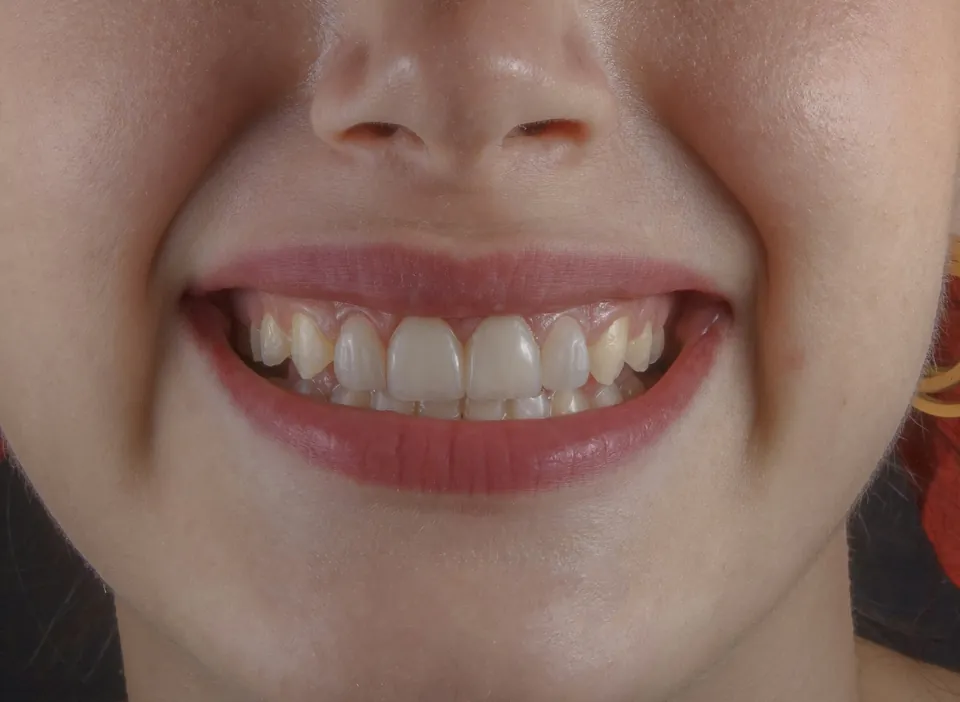 Close-up of a smile used for the shade preview